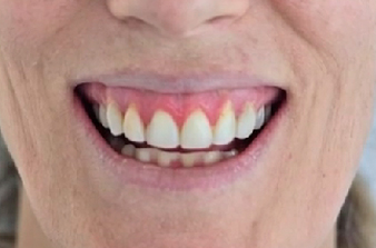 antes-caso2